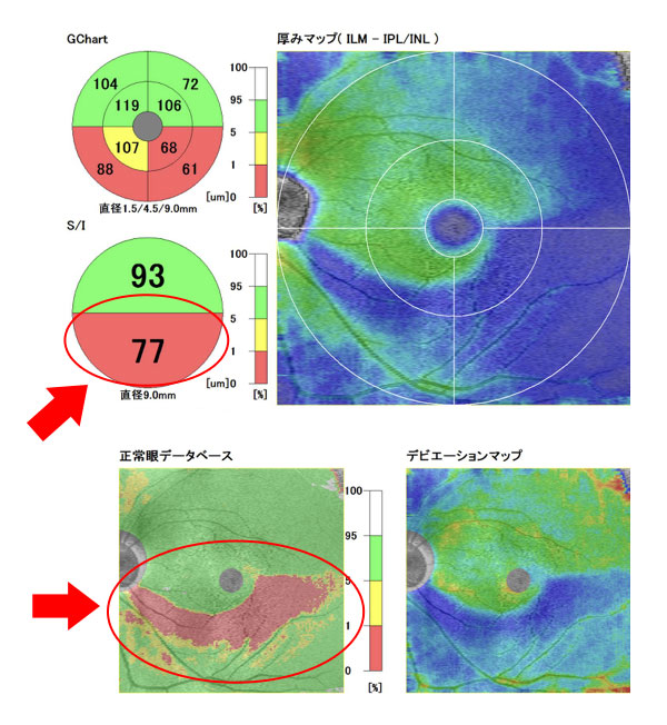 東高円寺眼科のOCT(光干渉断層計)緑内障早期発見